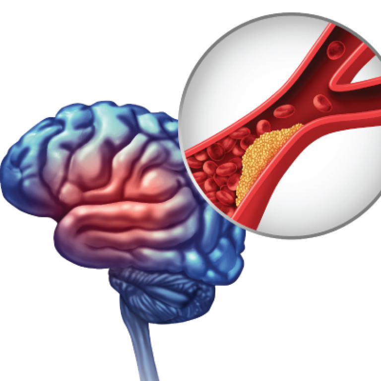 Brain Hemorrhage Surgery