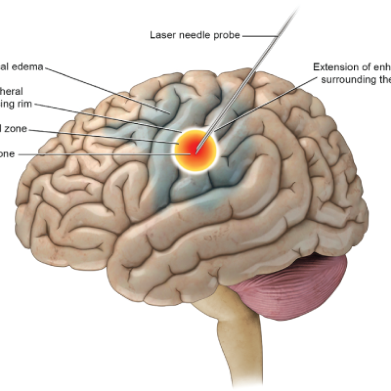 Epilepsy Surgery