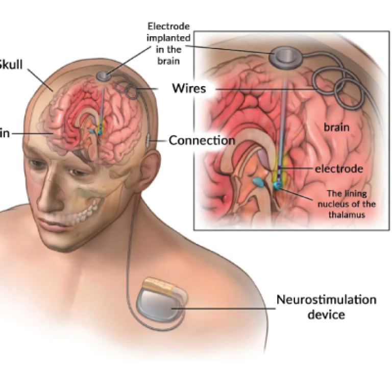 Functional Neurosurgery