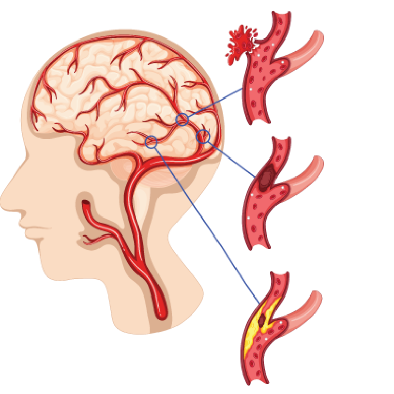 Vascular Neurosurgery